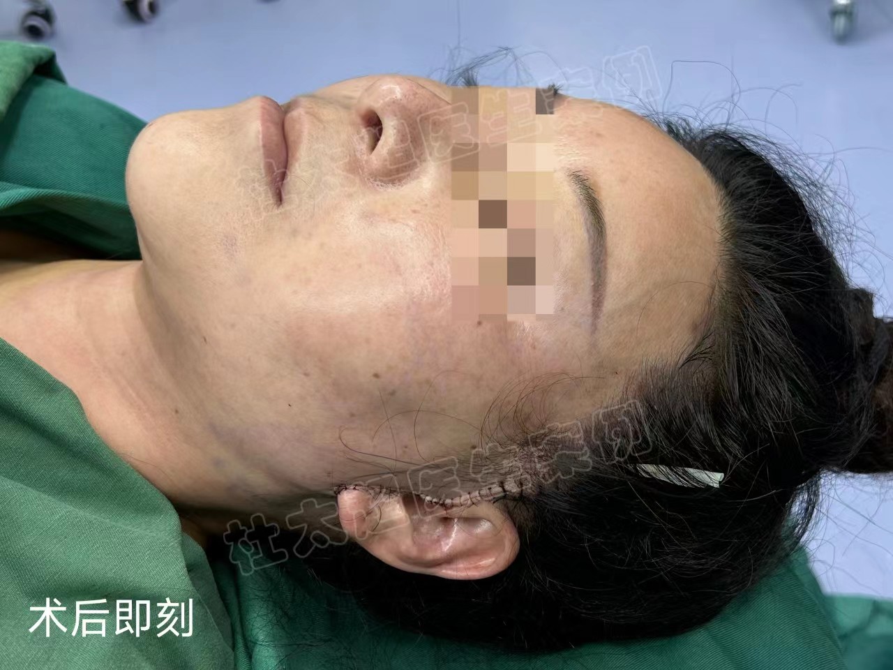 47岁苹果肌下垂，拉皮提升帮她扭转乾坤