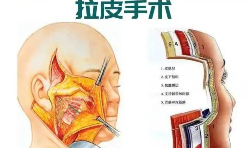 做拉皮手术，术前一定要了解这几件事！