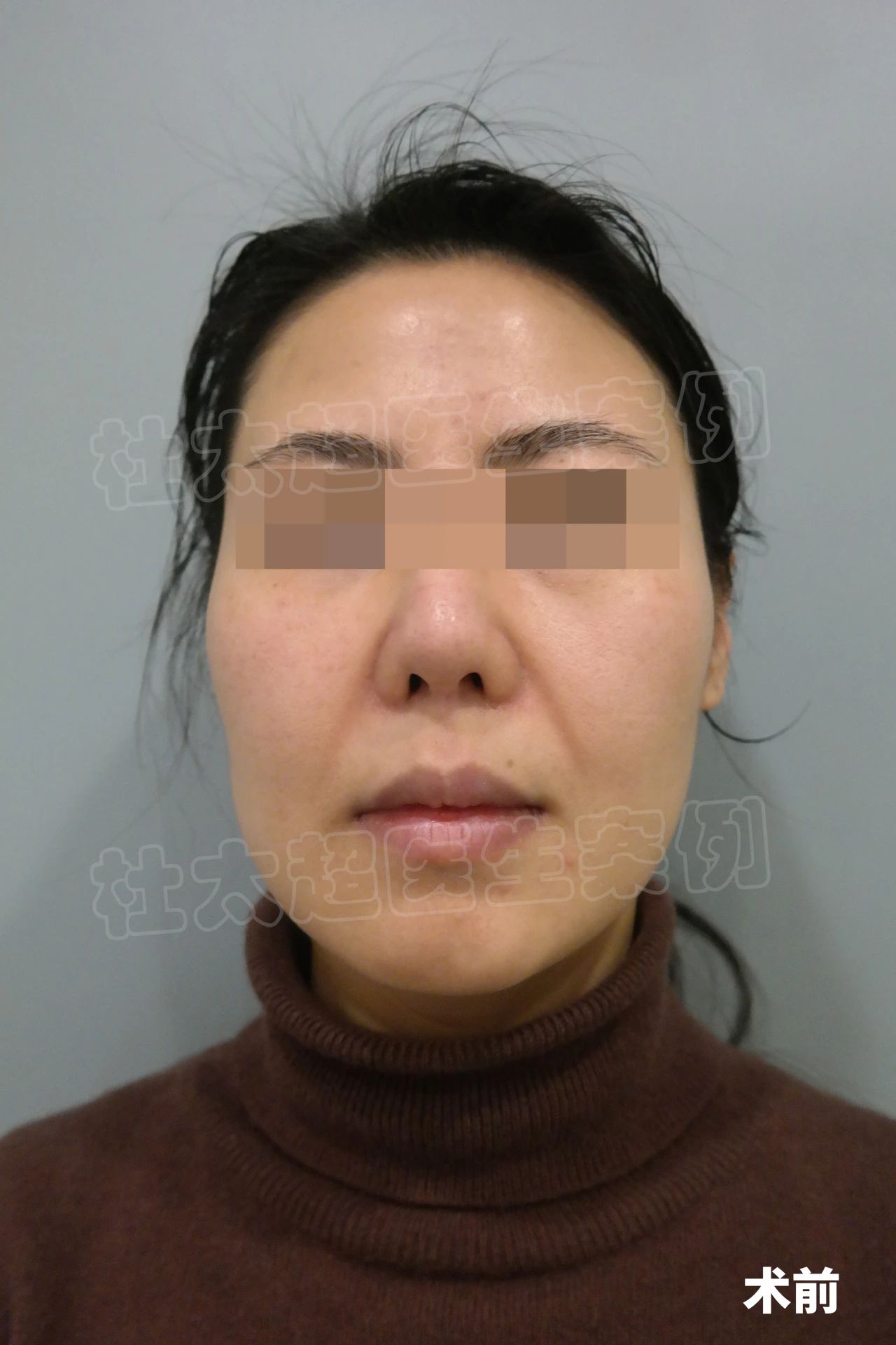 39岁忍不了“松垂脸”，来黄寺拉皮手术，一个月仿佛换了一张脸！