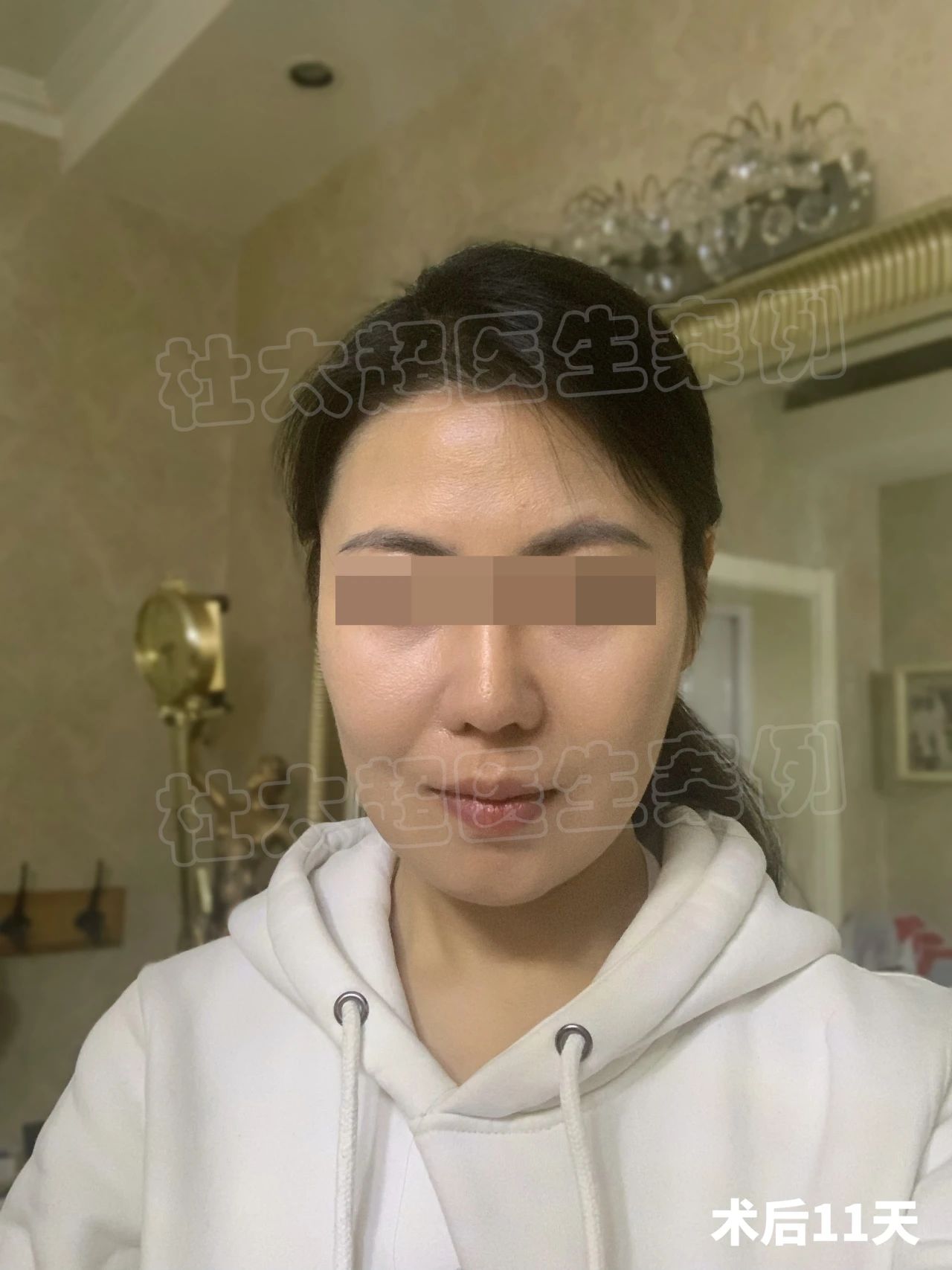 39岁忍不了“松垂脸”，来黄寺拉皮手术，一个月仿佛换了一张脸！