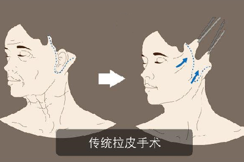 一篇文章，带你了解什么是caw小切口面部提升术？