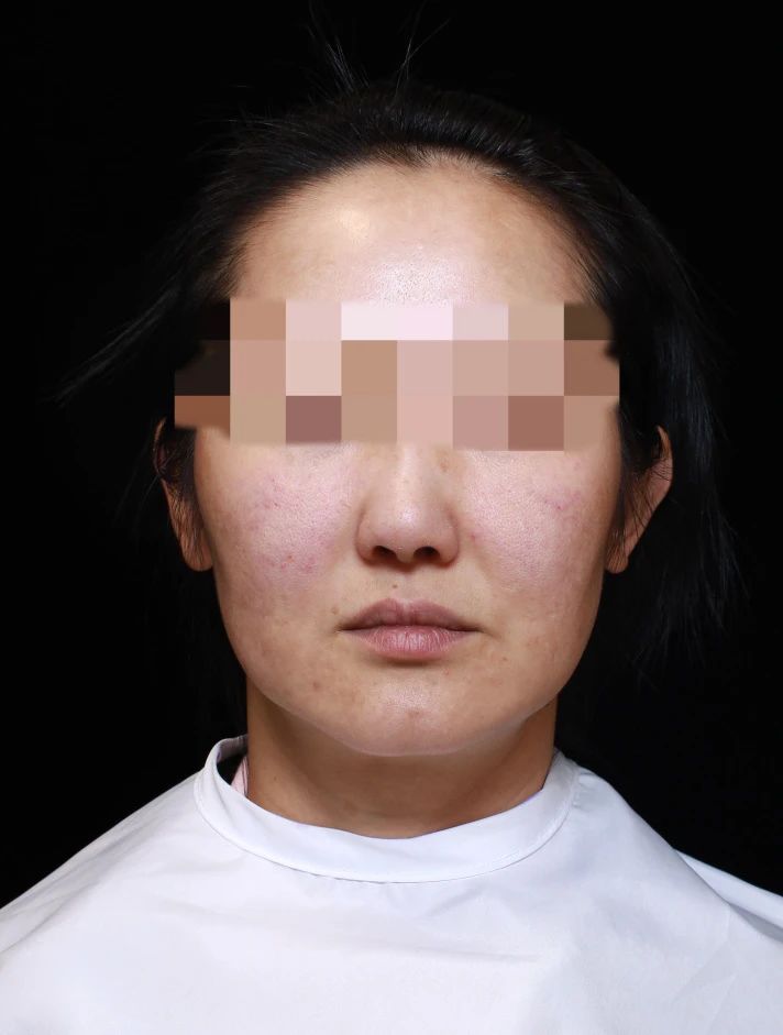 45岁，害怕国外医生，回国寻找青春——术后8天内心独白！