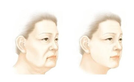 为什么拉皮手术成为了很多人的选择？