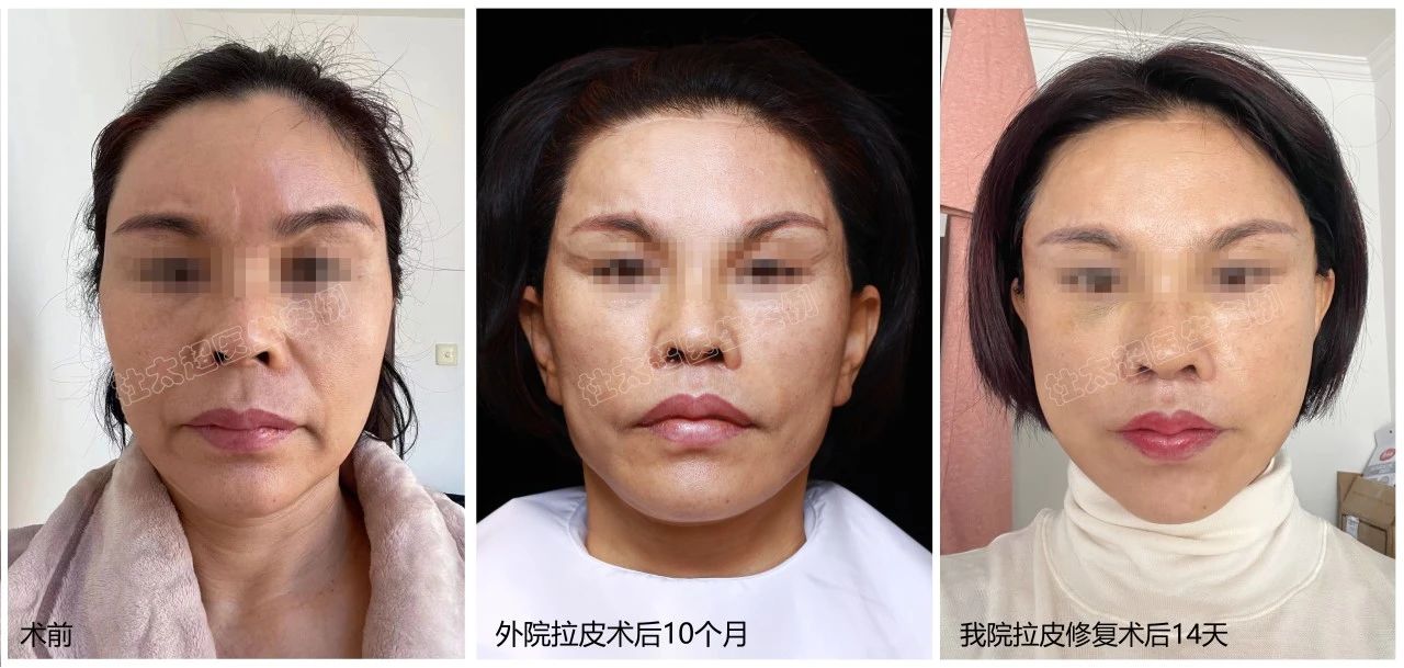 52岁，上海拉皮失败后的翻身之路：杜太超教授修复全过程分享！（胆小者慎入）