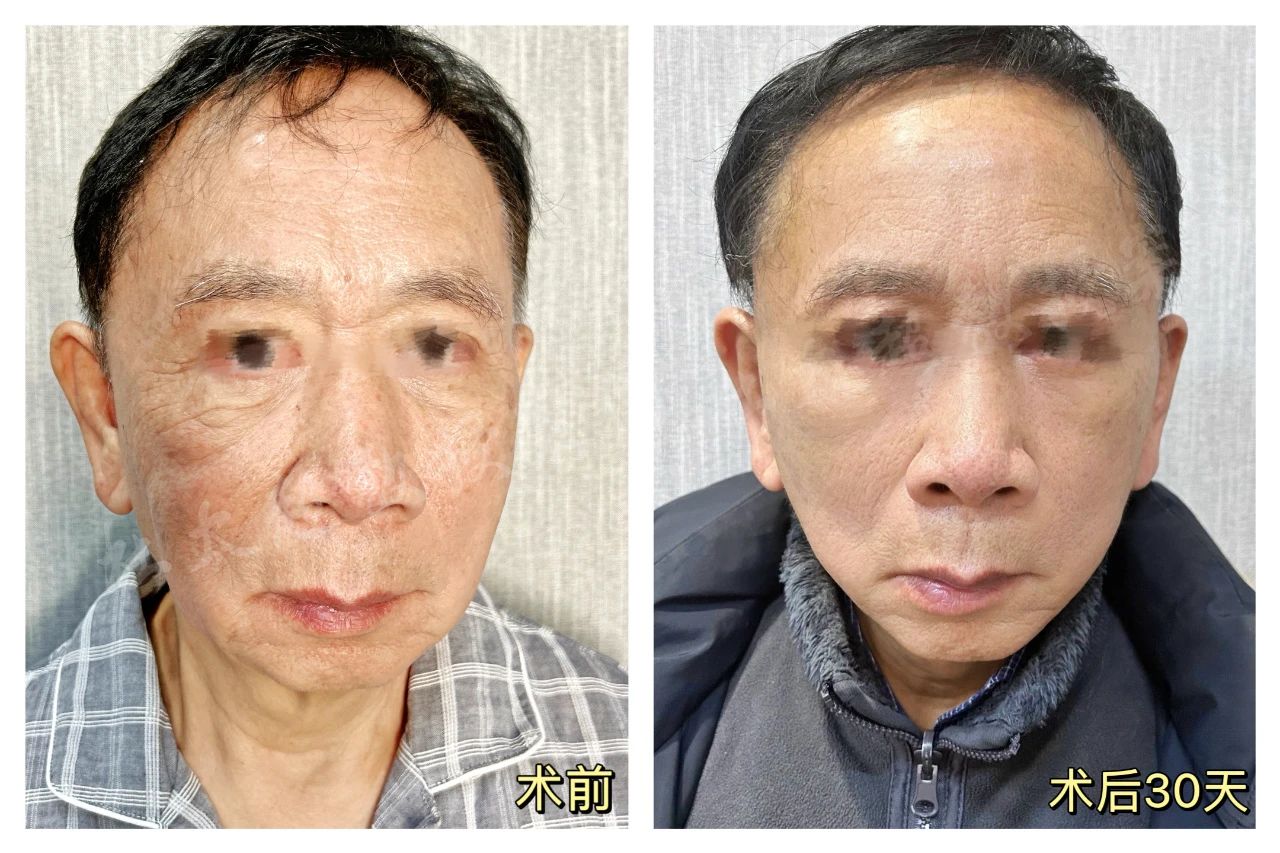 73岁男士拉皮术后分享，谁说“年龄”是做拉皮手术的禁区？