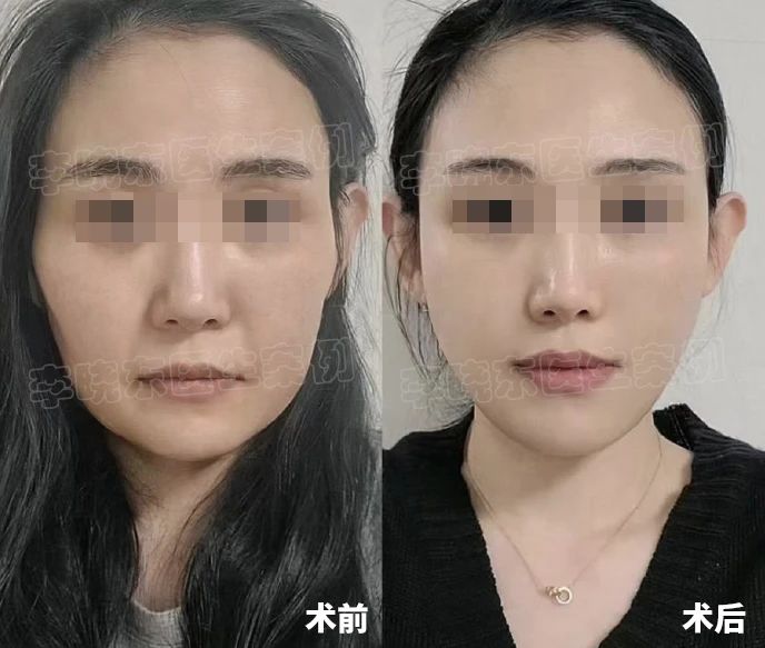 为什么经常听到求美者拉皮后悔的声音，听听整形医生讲