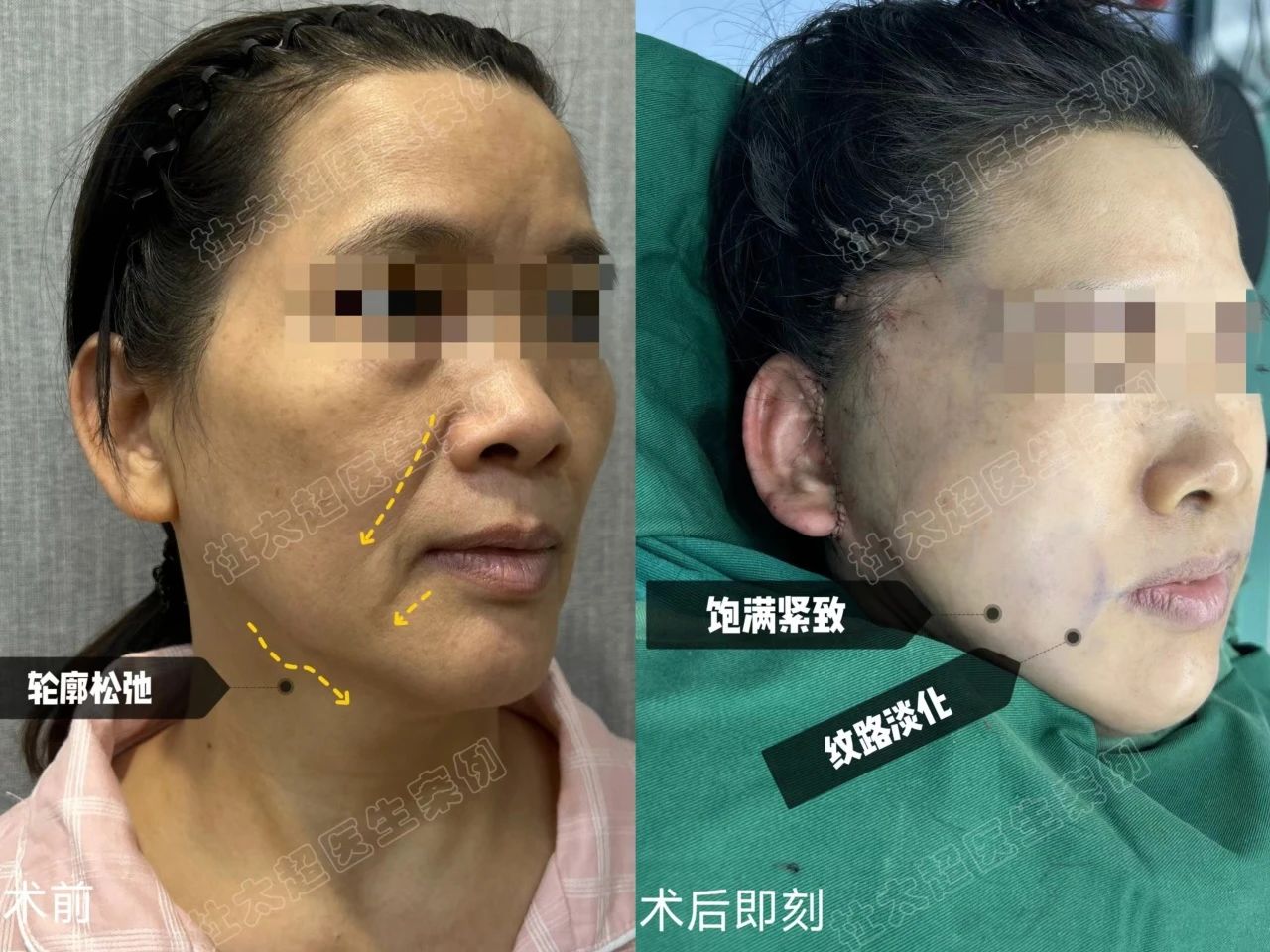 52岁的我通过亲身经历,分享拉皮和切眉手术的全过程! 52岁的我通过亲身经历,分享拉皮和切眉手术的全过程!
