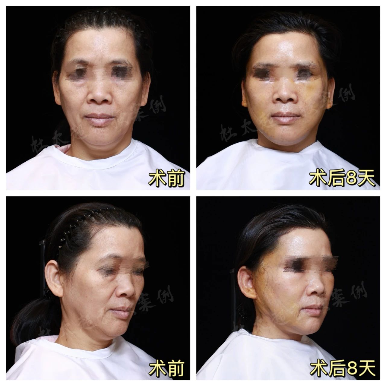 52岁的我通过亲身经历,分享拉皮和切眉手术的全过程! 52岁的我通过亲身经历,分享拉皮和切眉手术的全过程!