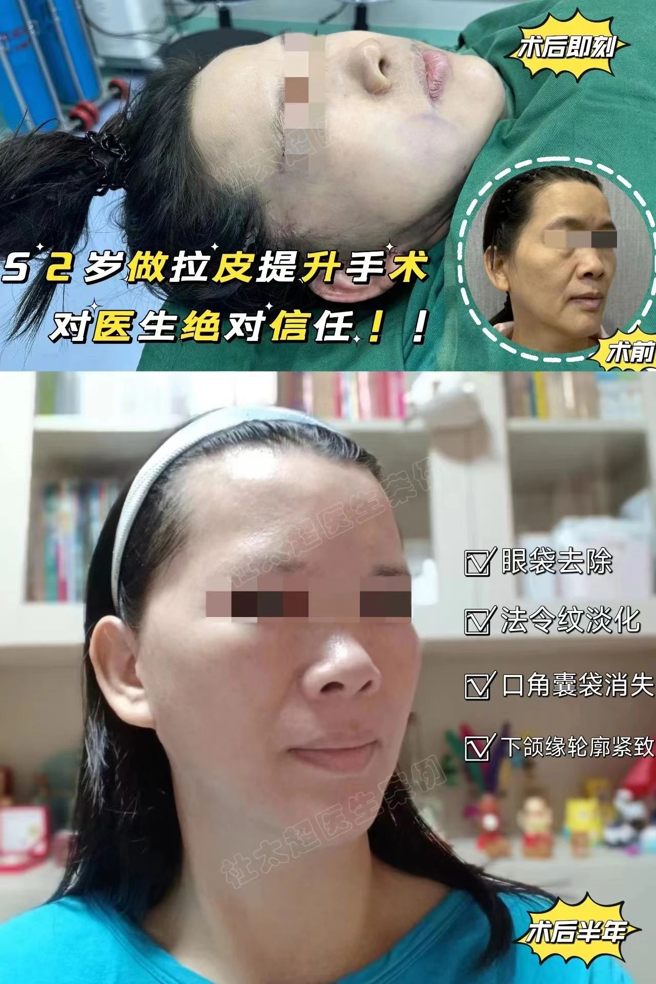 52岁的我通过亲身经历,分享拉皮和切眉手术的全过程! 52岁的我通过亲身经历,分享拉皮和切眉手术的全过程!