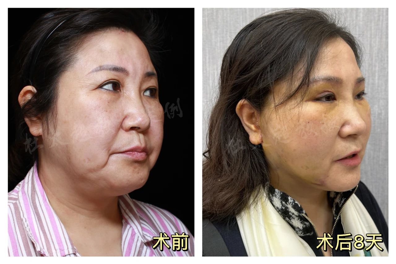 55岁惊天逆袭：我如何借拉皮手术重获青春和友谊！