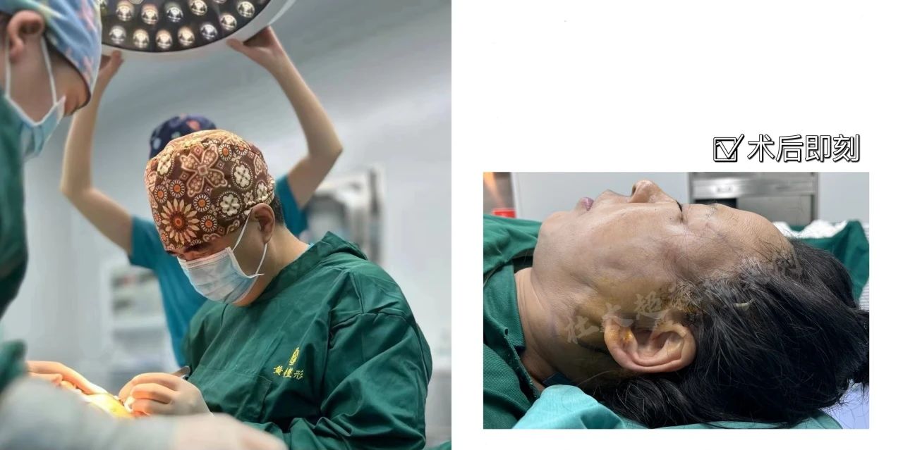 61岁勇者，术后9天修复，我只信任杜太超教授的拉皮修复手术！