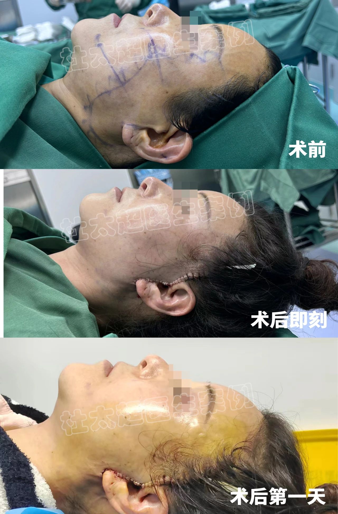 从忐忑到自信：一场拉皮手术改变人生的感人故事！