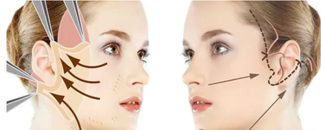 PSV面部提升能维持多久？看整形医生怎么说!