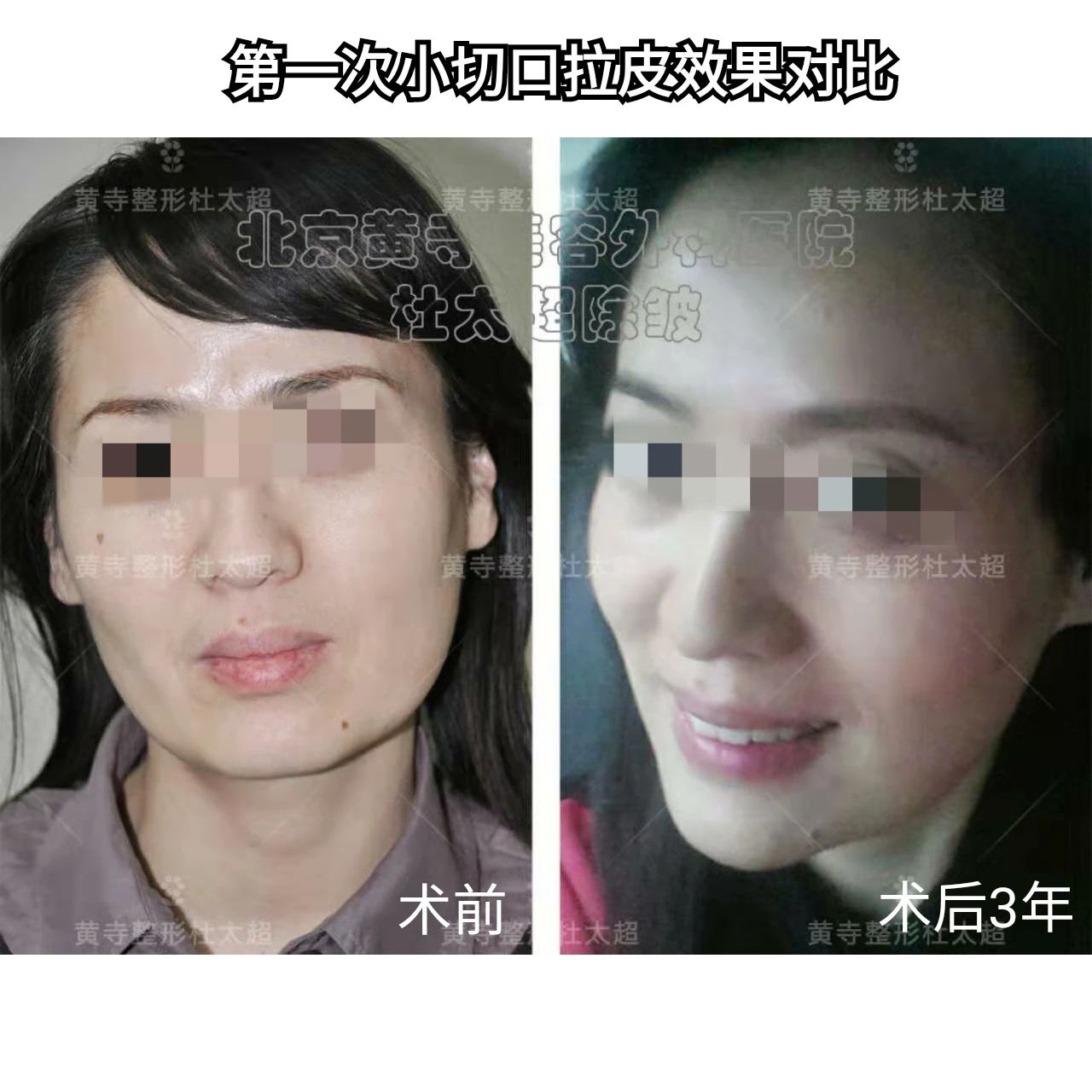 十五年！两次拉皮手术挑战岁月，对杜太超医生的敬佩与信赖！