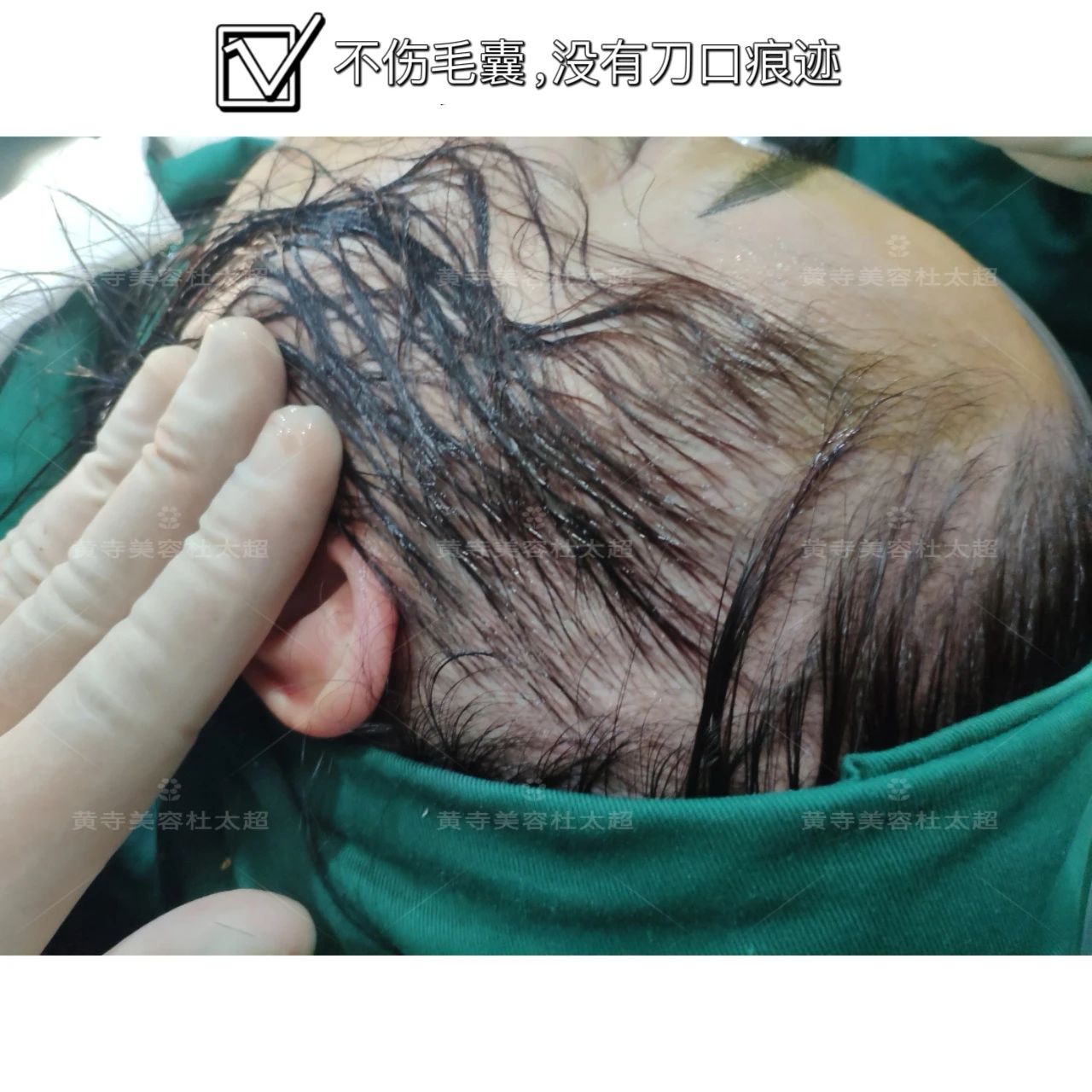 十五年！两次拉皮手术挑战岁月，对杜太超医生的敬佩与信赖！