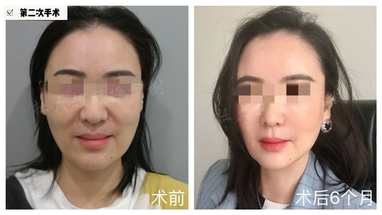 十五年！两次拉皮手术挑战岁月，对杜太超医生的敬佩与信赖！