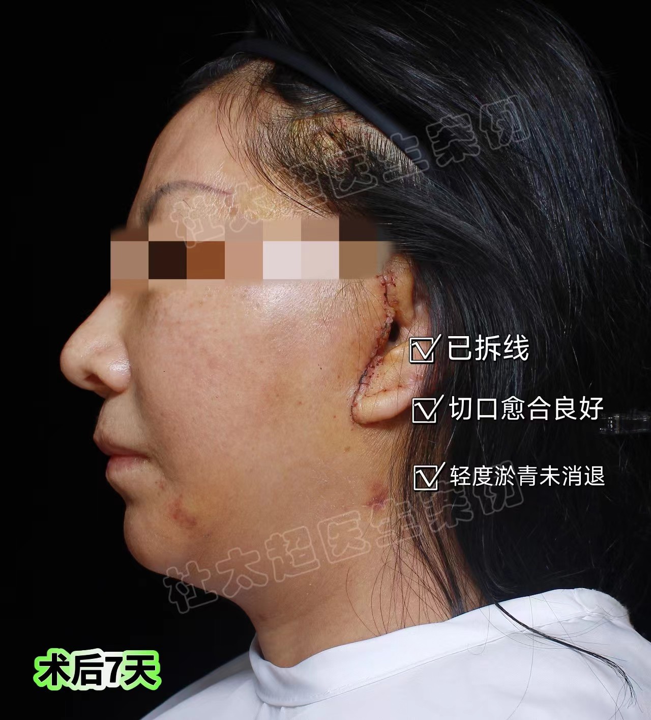 拉皮手术第7天、20天、30天实拍记录，脸大变样！