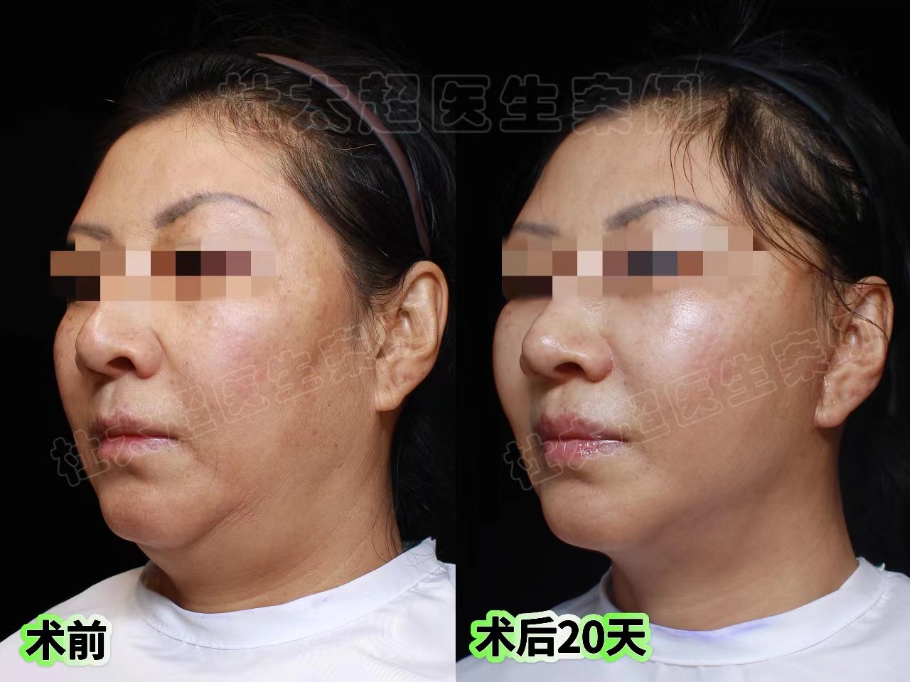 拉皮手术第7天、20天、30天实拍记录，脸大变样！