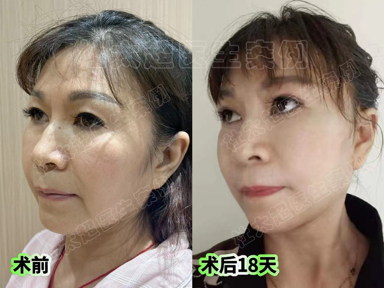 58岁跨越大半个中国，到北京挑战拉皮，术后2个月找回青春