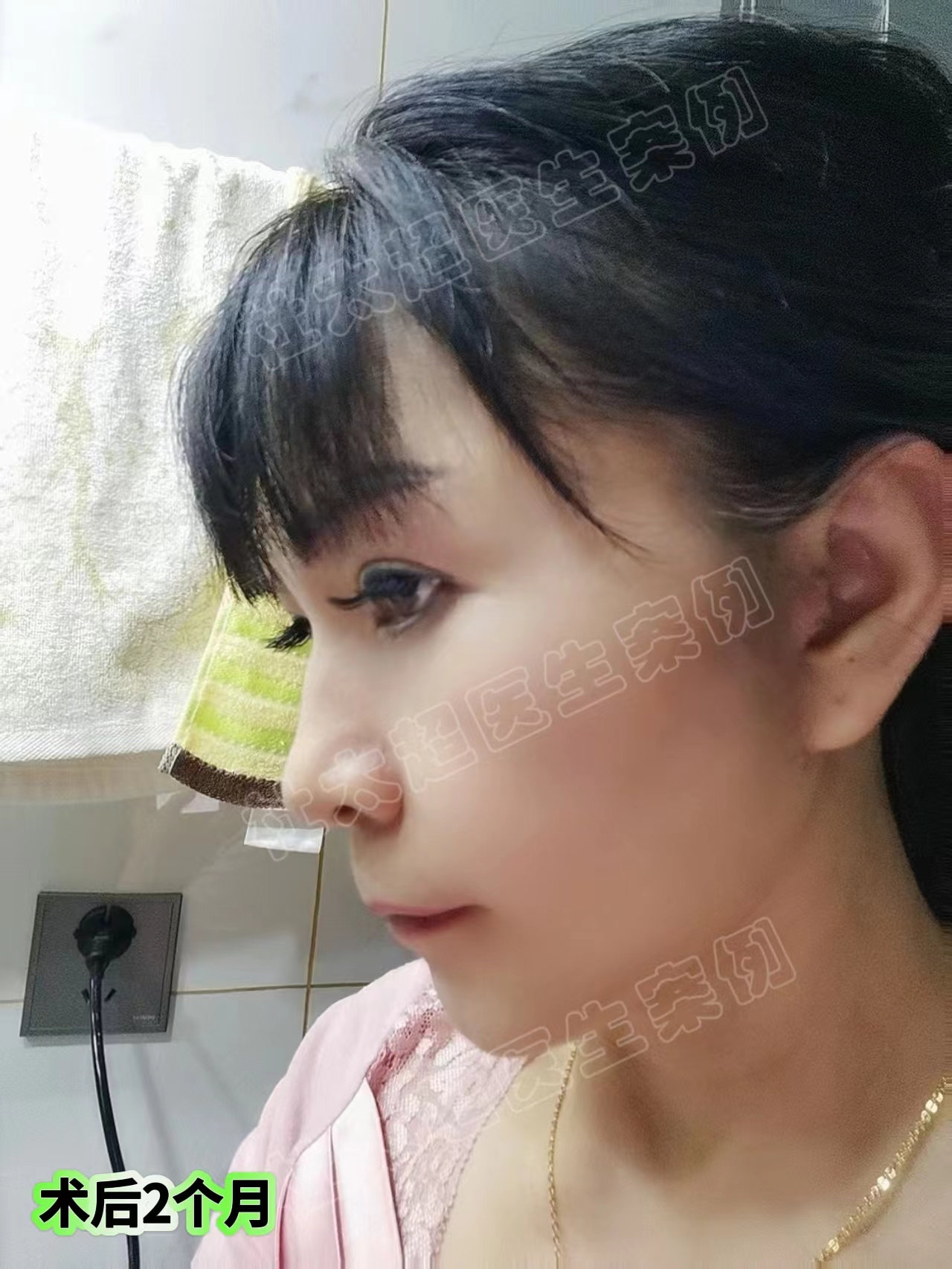 58岁跨越大半个中国，到北京挑战拉皮，术后2个月找回青春