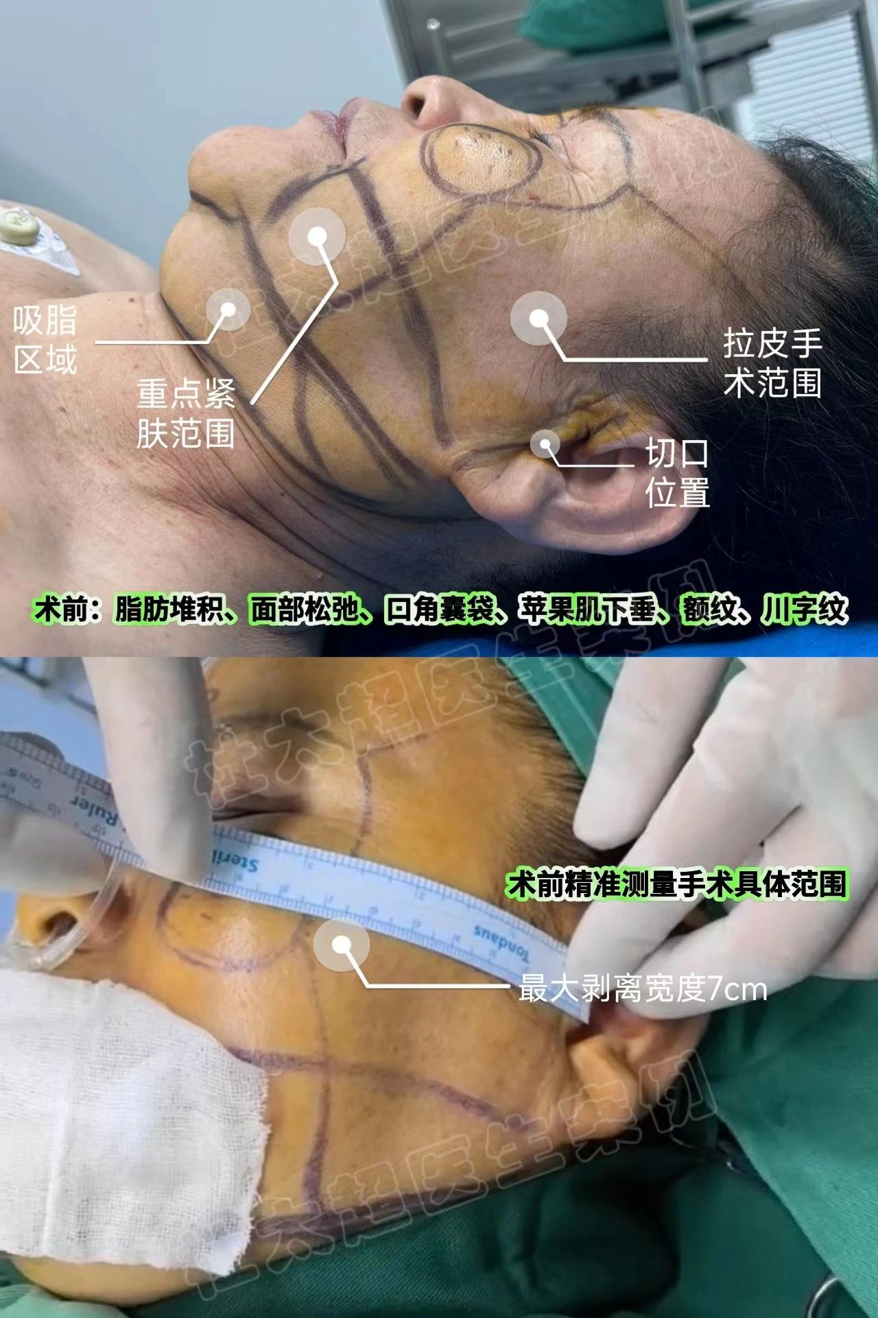 假拉皮的陷阱：如何选择正规的拉皮手术并避免手术效果的消失！