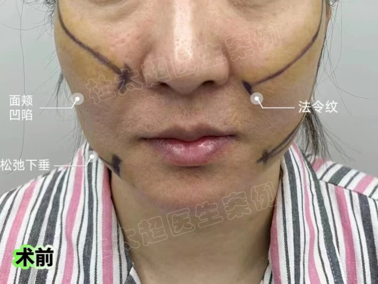 47岁不满法令纹深邃，通过拉皮手术找回自信