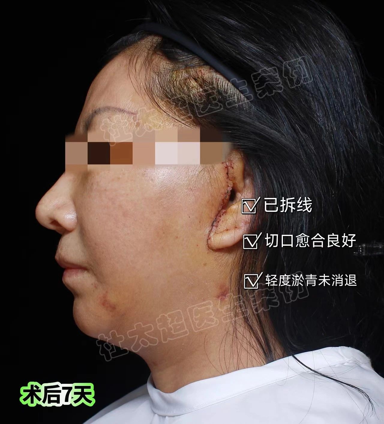 由内而外：从拉皮手术中追寻我自己的美丽之旅