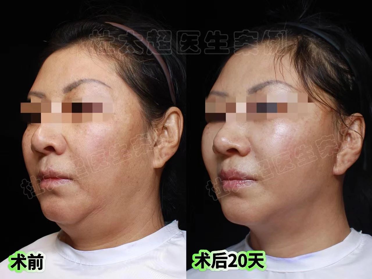 由内而外：从拉皮手术中追寻我自己的美丽之旅