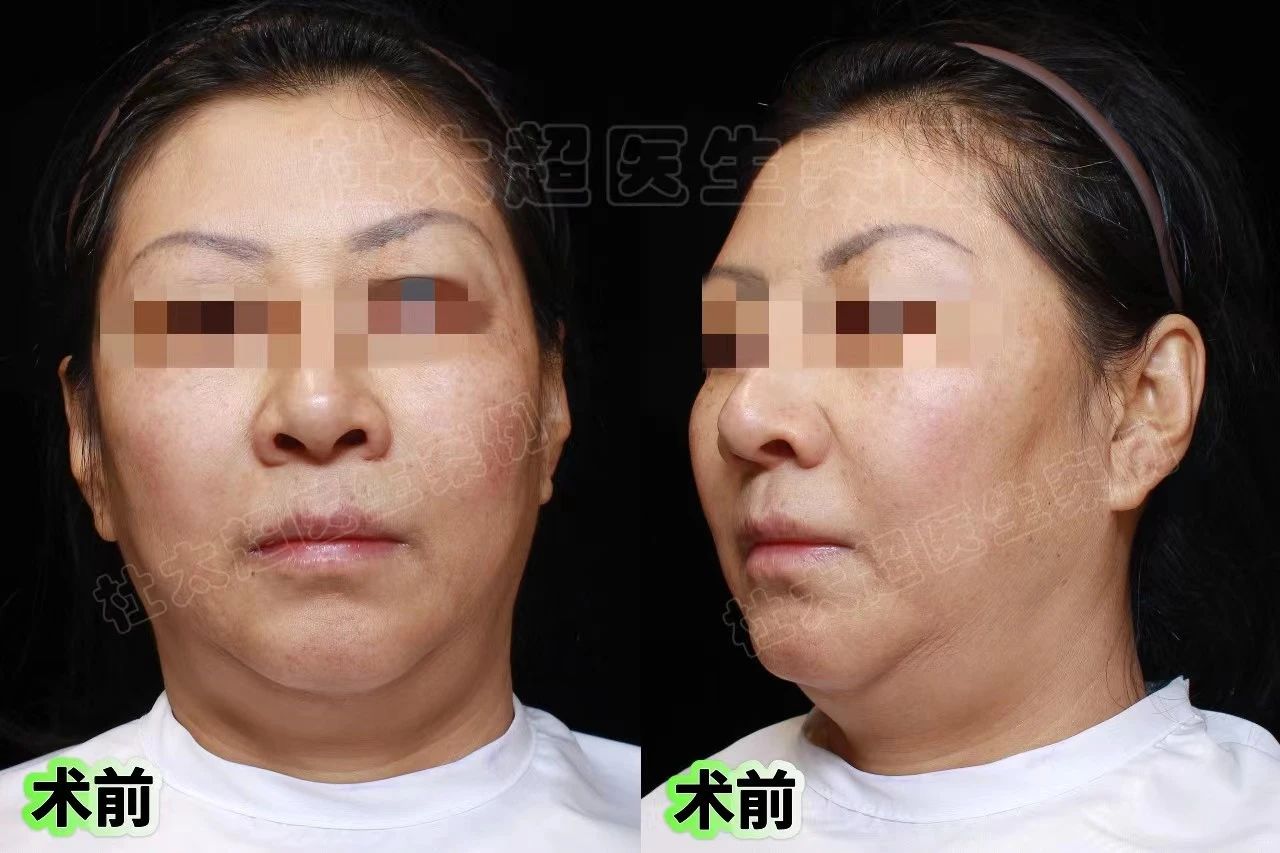 由内而外：从拉皮手术中追寻我自己的美丽之旅