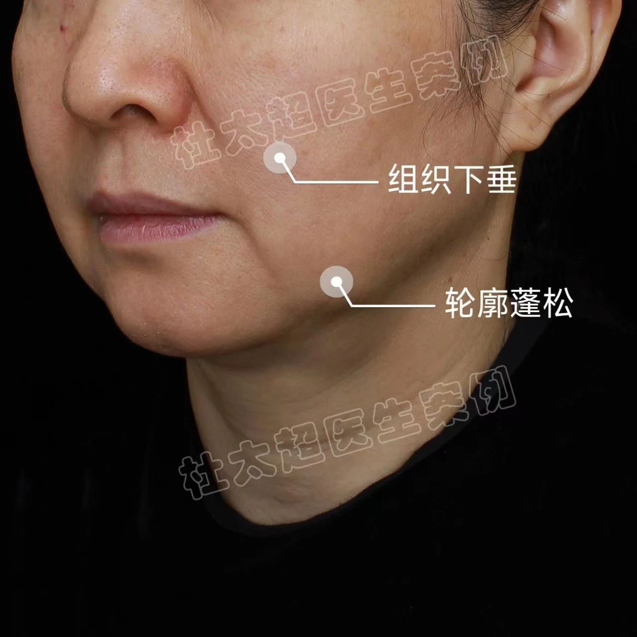 皮肤松弛导致口周老化明显，这样做改变整体的“年轻态”！