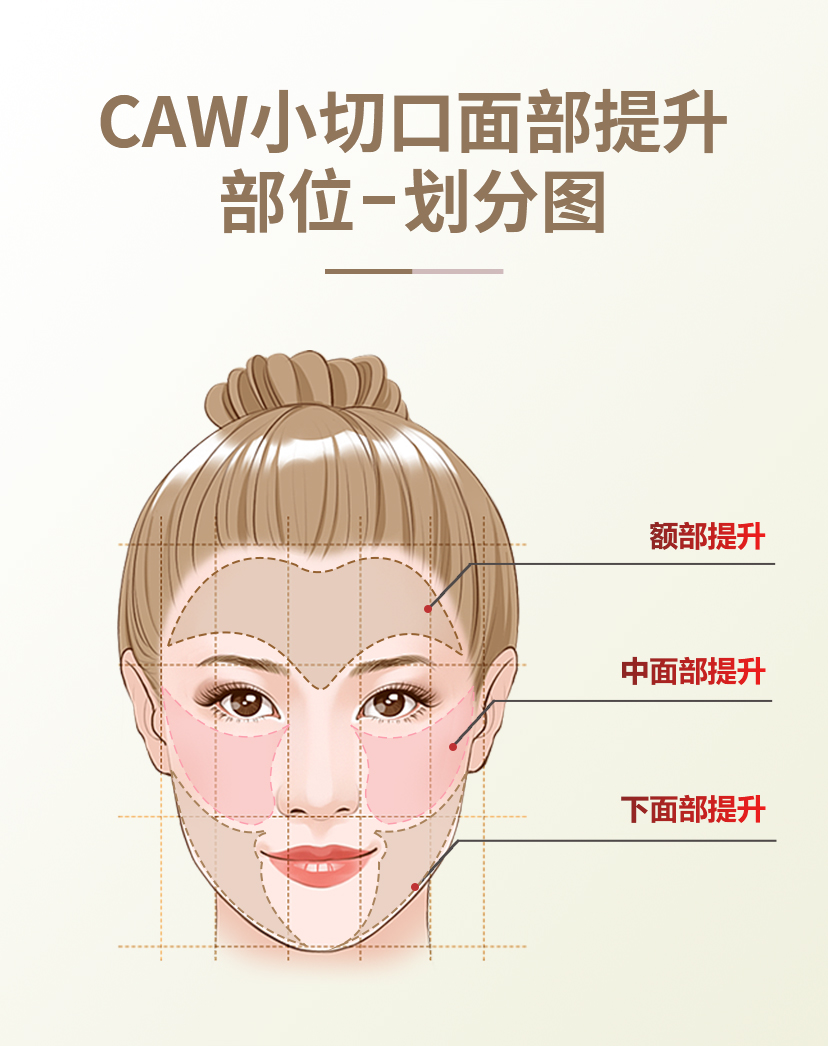 Caw小切口面部提升与传统拉皮、线雕、注射除皱、光电除皱的区别