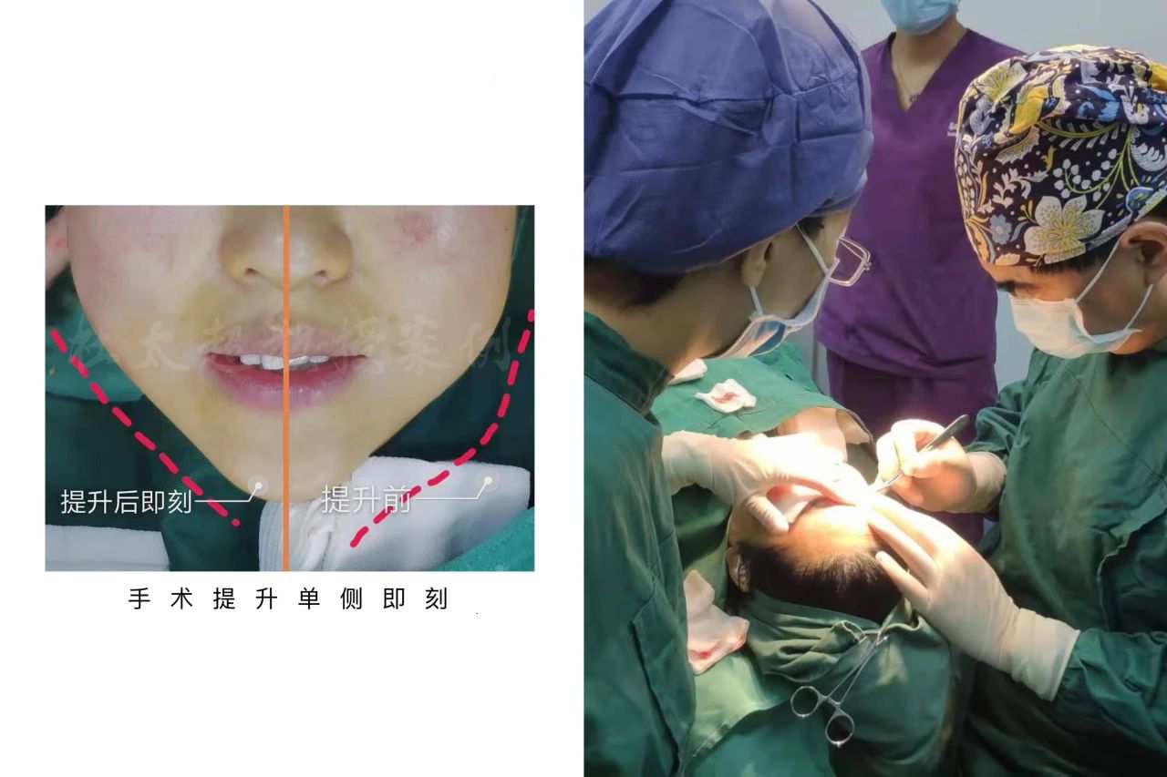 惊人逆袭！41岁妈妈，借拉皮手术逆转衰老，改头换面惊艳全场！