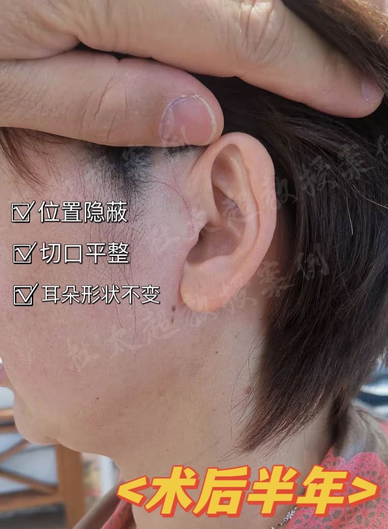 惊人逆袭！41岁妈妈，借拉皮手术逆转衰老，改头换面惊艳全场！