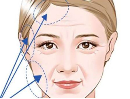 47岁，拉皮1个月后真实情况，来看看过来人经验分享！