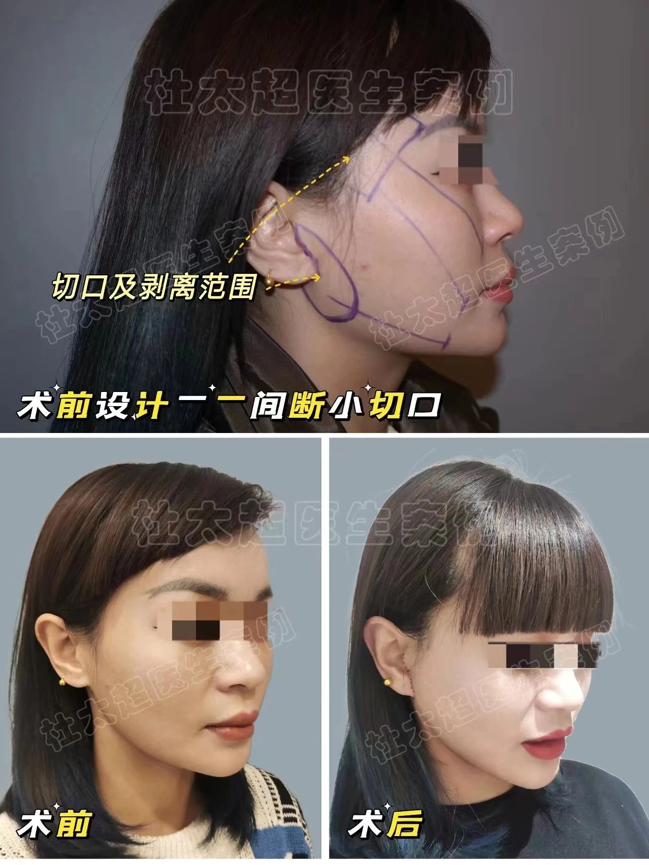 轻松抗衰！深度揭秘拉皮手术的神秘切口设计