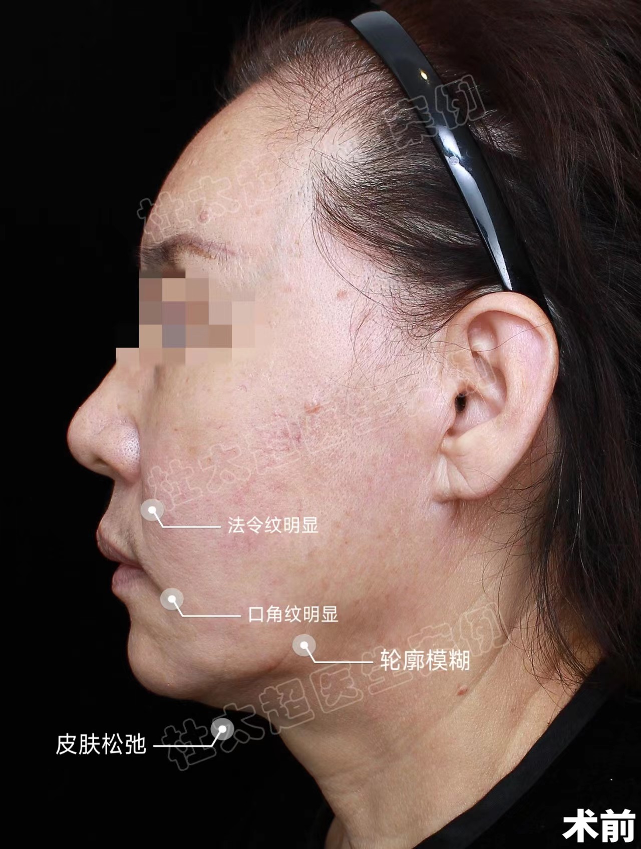 63岁面部松垮下垂，多次做项目改善，都不及拉皮效果确切