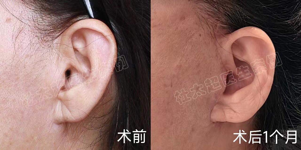 63岁面部松垮下垂，多次做项目改善，都不及拉皮效果确切