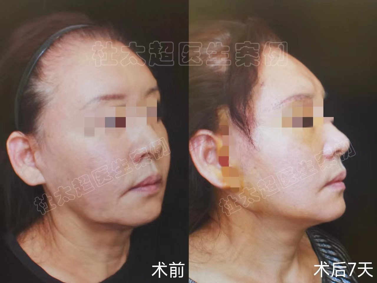 63岁面部松垮下垂，多次做项目改善，都不及拉皮效果确切