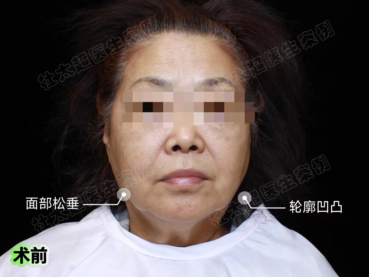 真人案例展示，拉皮确实比线雕强一万倍