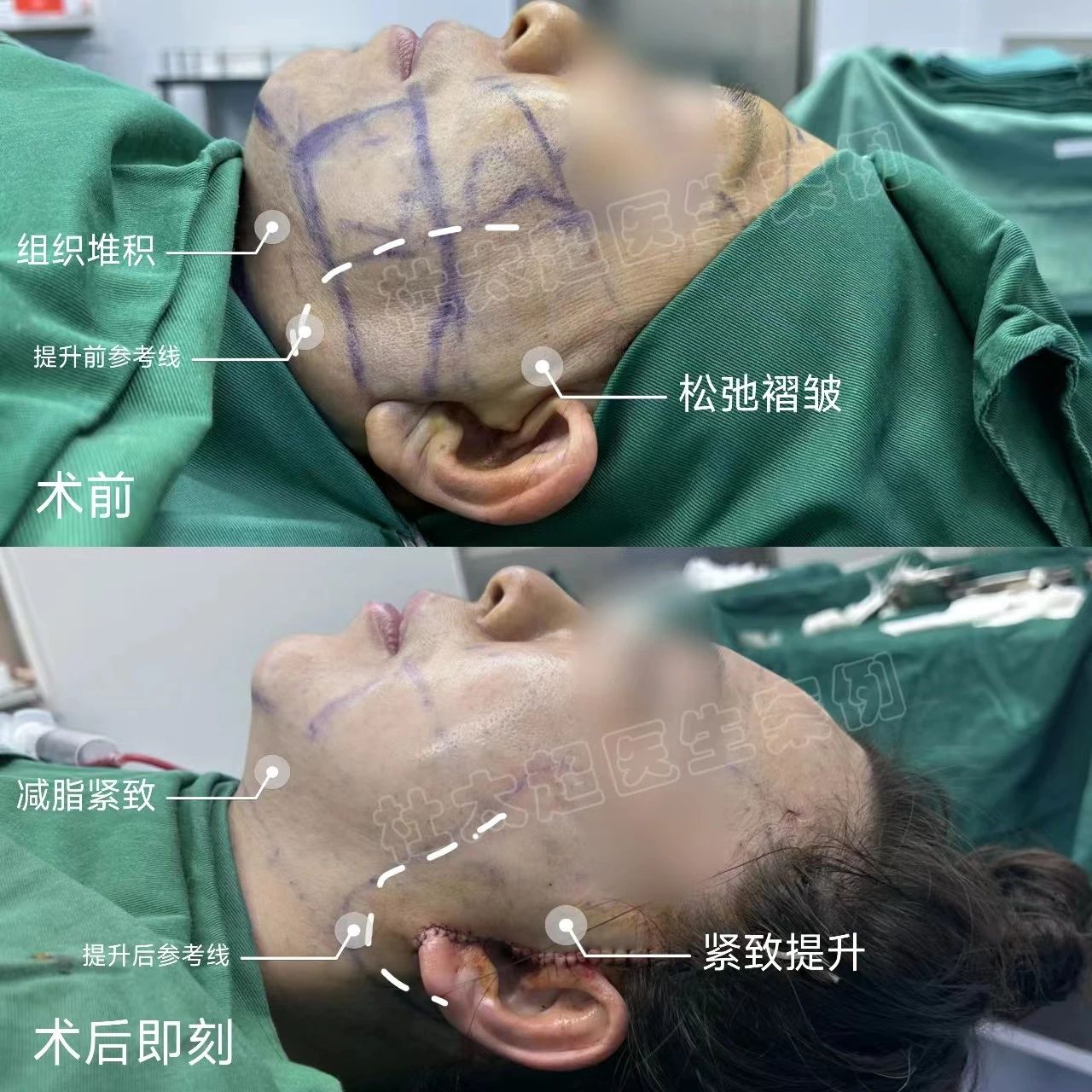 您还在怕拉皮手术吗？！揭秘手术创伤和术后清醒状态的真相！