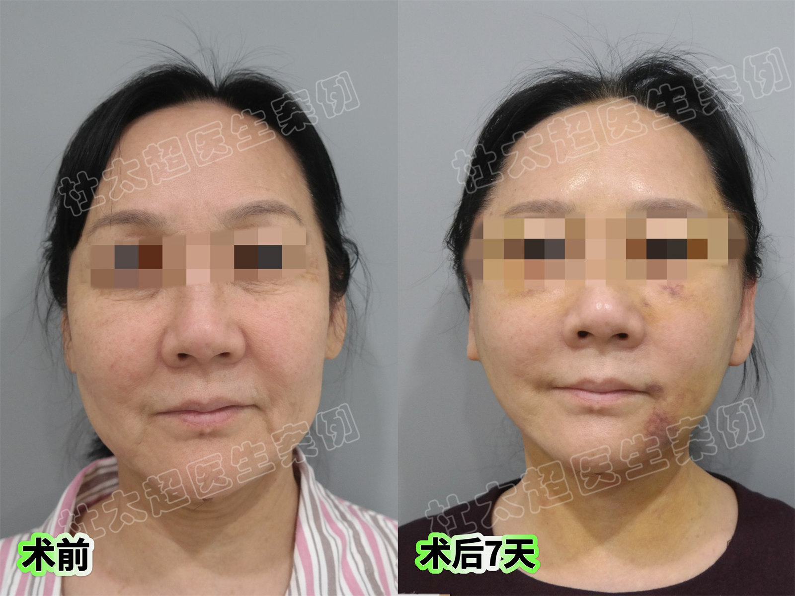 安享晚年的年纪做了拉皮手术，结果爆改成功！