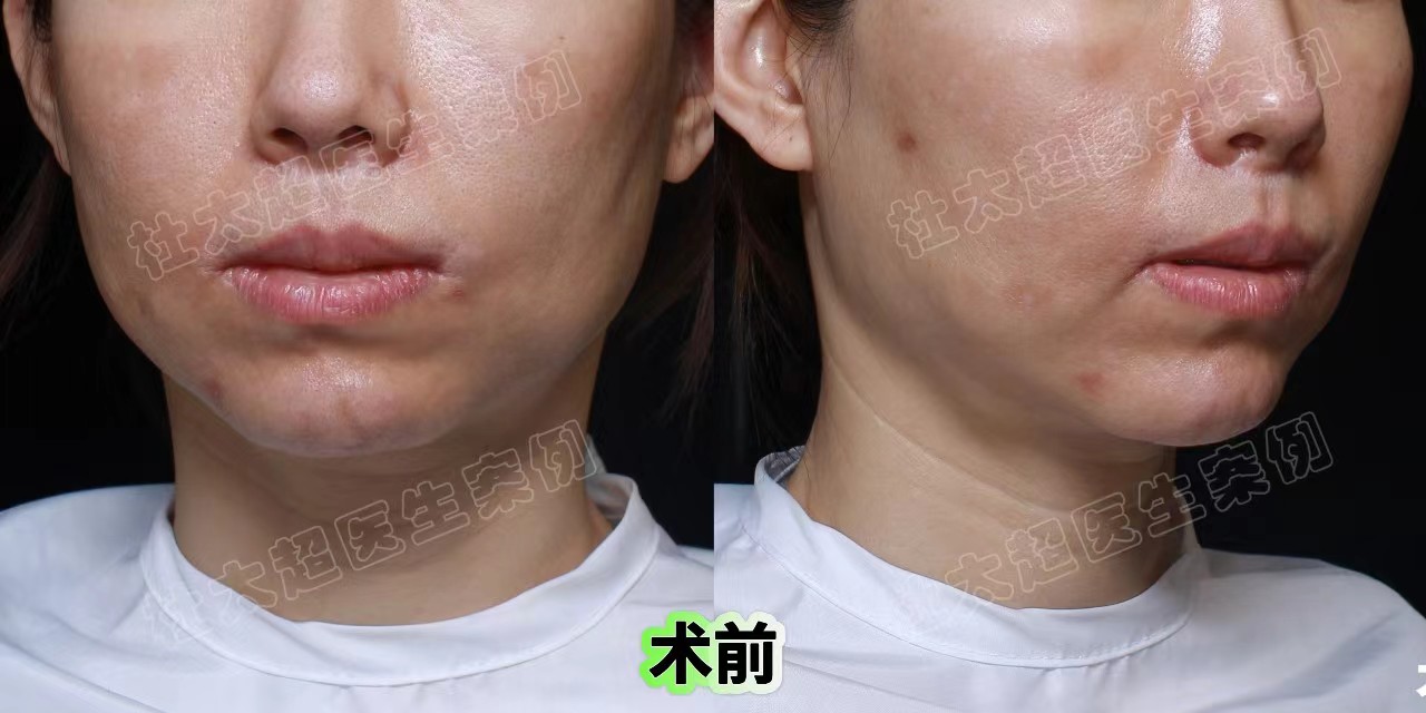 自信新生，拉皮手术终于让我成为了一个有下颌线的魅力女人