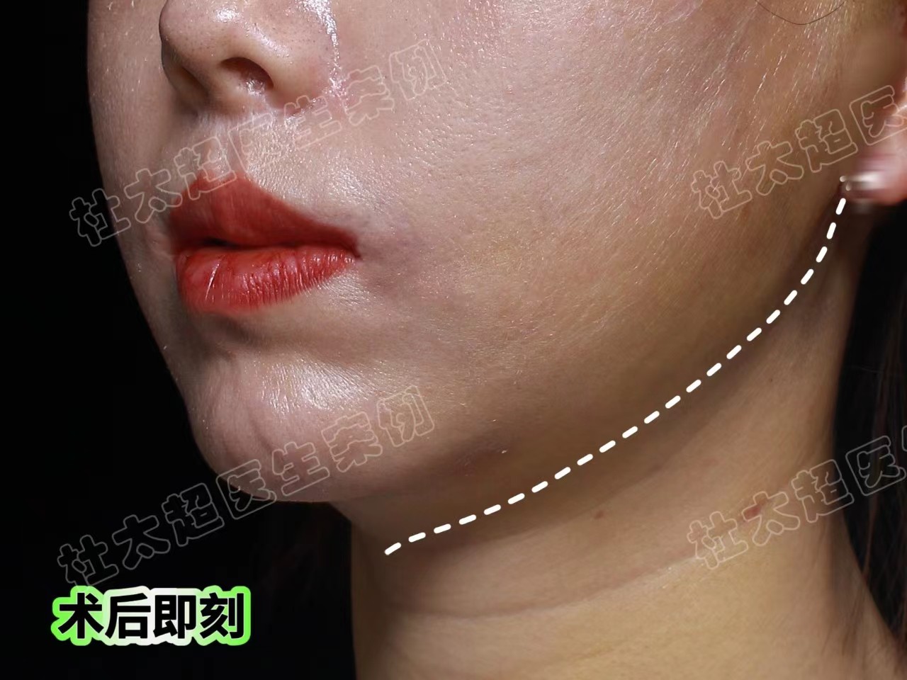 自信新生，拉皮手术终于让我成为了一个有下颌线的魅力女人