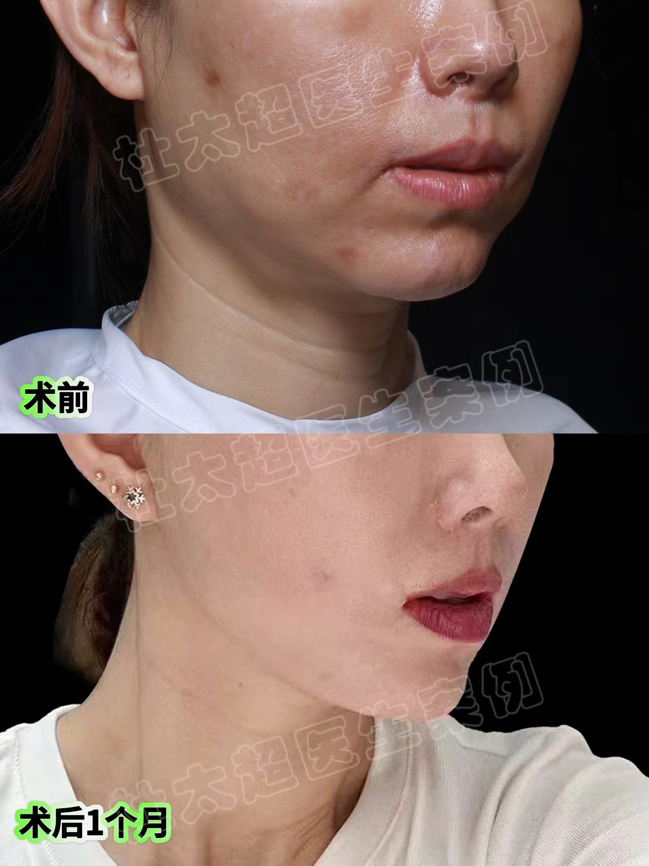 自信新生，拉皮手术终于让我成为了一个有下颌线的魅力女人