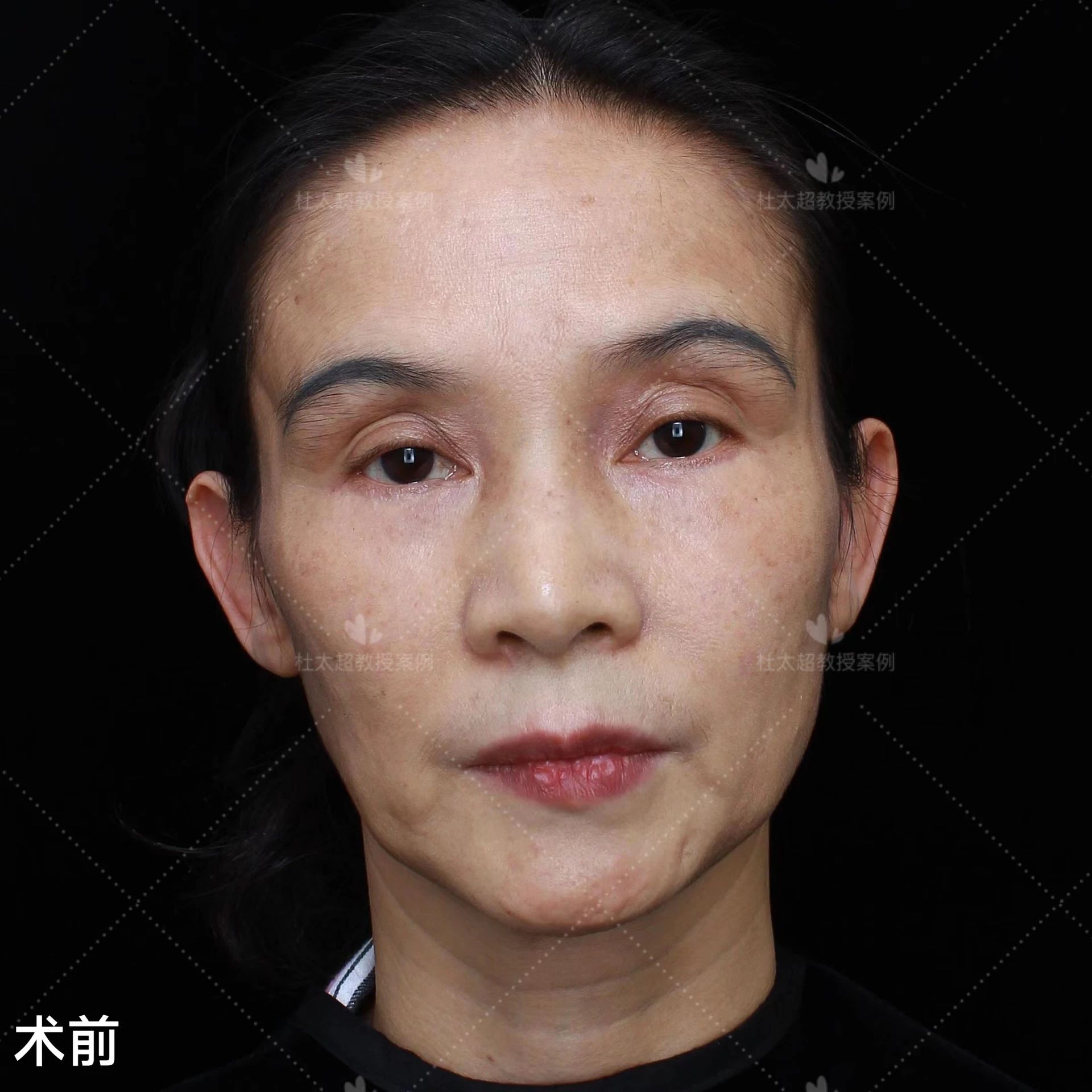 拉皮手术好不好？45岁比同龄人显老，不甘心向岁月妥协，做了拉皮手术效果惊呆了！