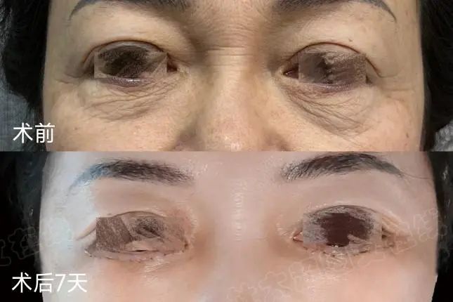 拉皮手术哪家好？重获青春：我的美丽改变之旅！