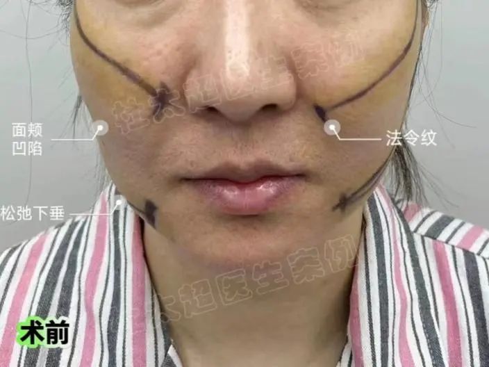 拉皮效果好不好？48岁的我历经多种方式，终于重新活过来了！