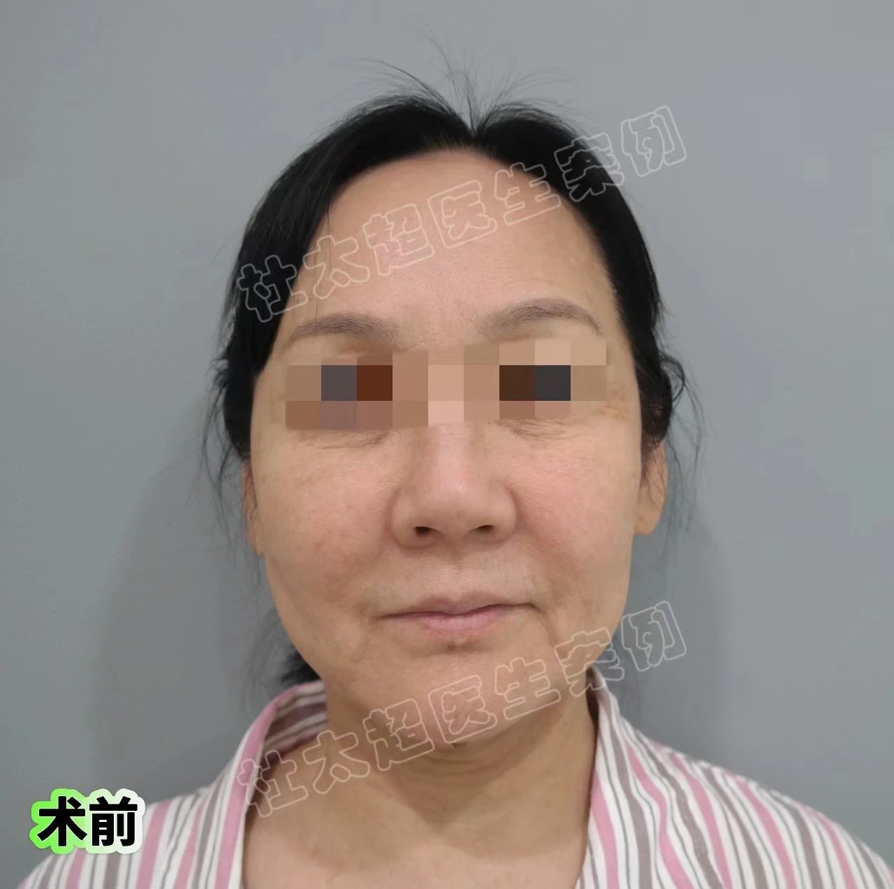 拉皮哪家强?60多了还“疯”,倔强选择拉皮手术! 拉皮哪家强?60多了还“疯”,倔强选择拉皮手术!