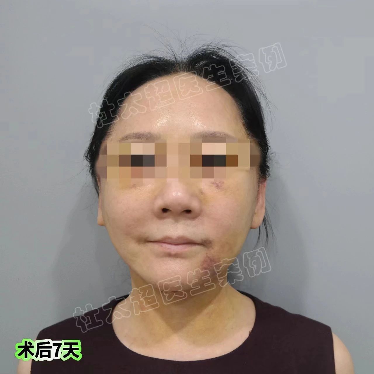 拉皮哪家强?60多了还“疯”,倔强选择拉皮手术! 拉皮哪家强?60多了还“疯”,倔强选择拉皮手术!