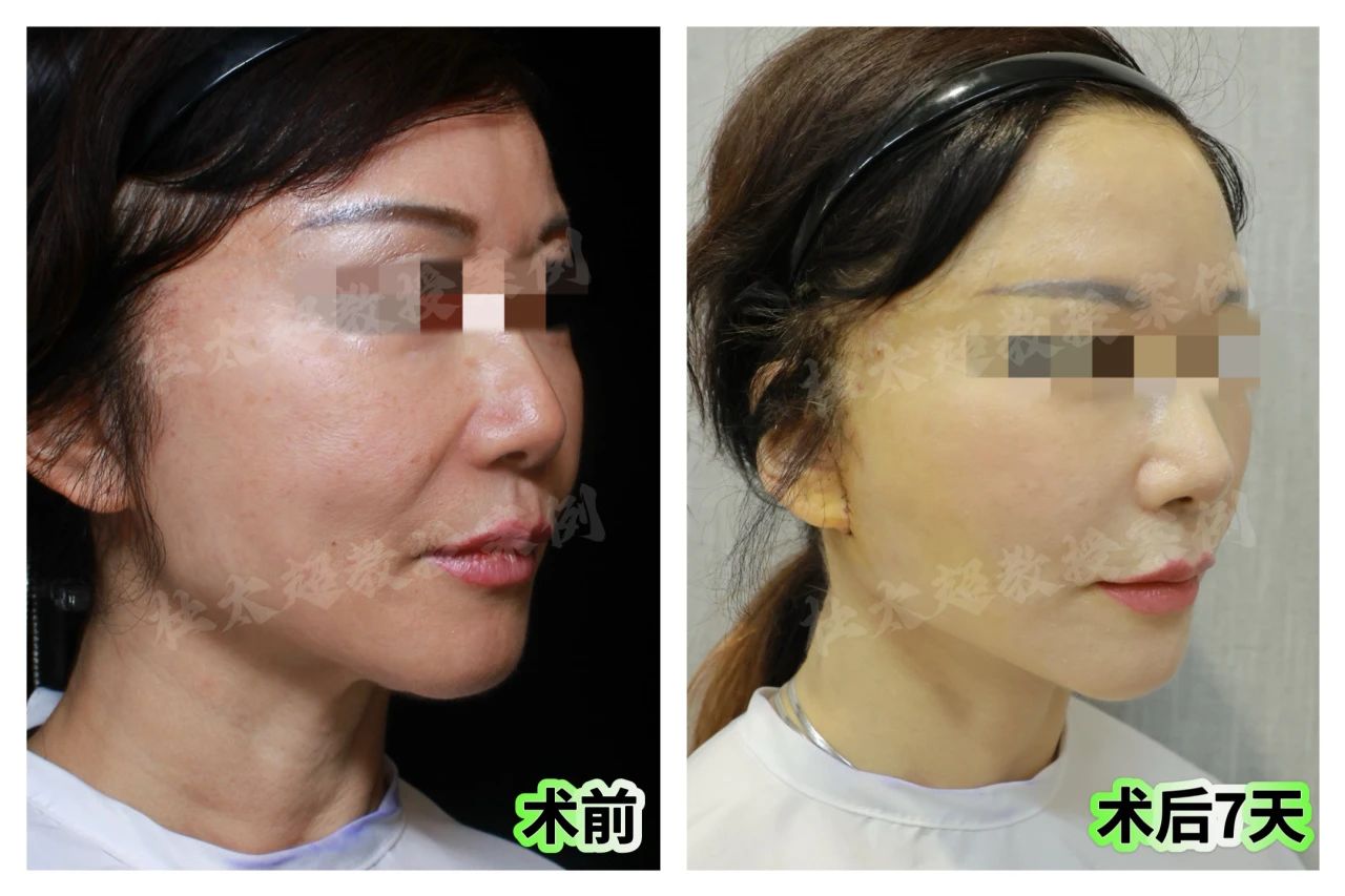 多大年龄能做拉皮？60岁处女座的青春逆袭，如何在细节中找回青春光芒！